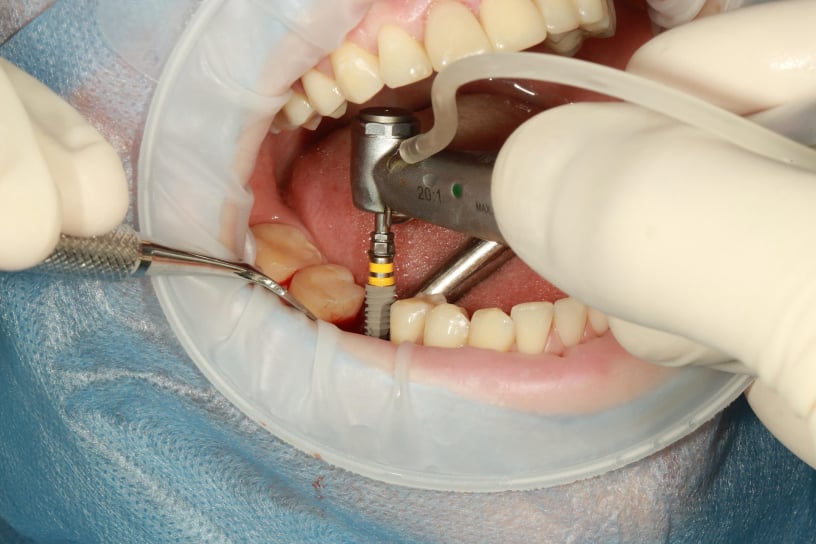 Implantes dentários